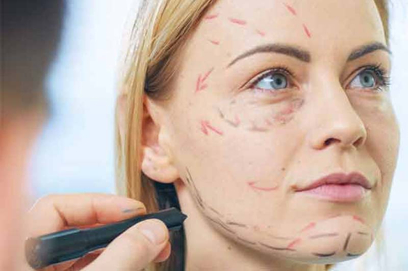 Post Face Lift